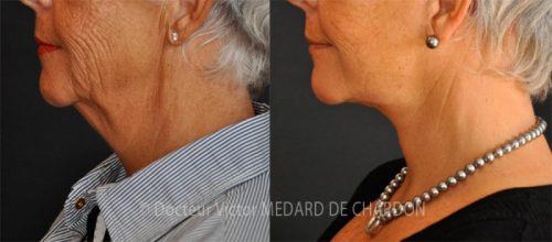 Lifting cervico-facial (lifting du visage et du cou) avec lipoaspiration du cou (double menton)