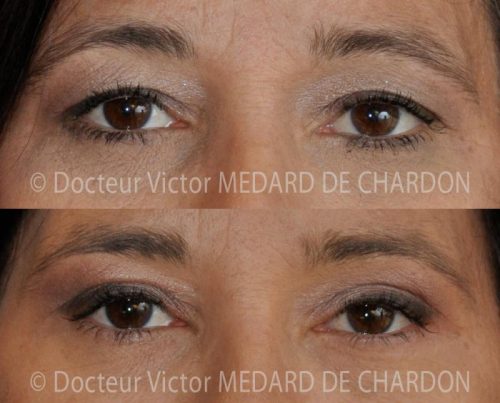 specialiste chirurgie paupieres nice cannes