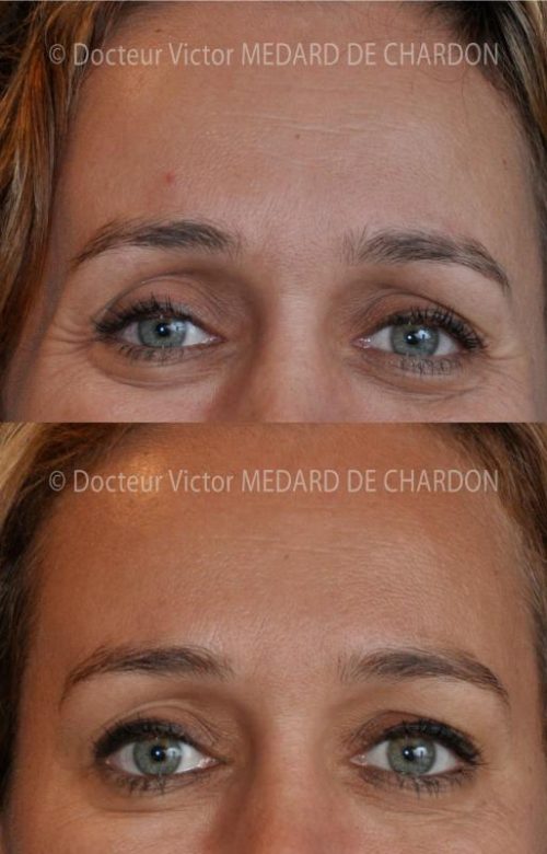 specialiste injection botox cannes
