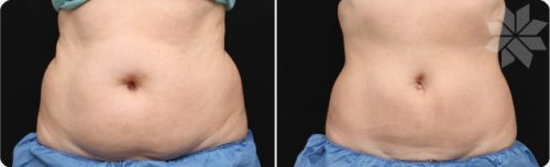 specialiste liposuccion sans chirurgie coolsculpting cryolipolyse alpes maritimes nice cannes