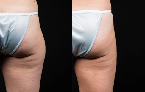 coolsculpting cuisses culotte cheval