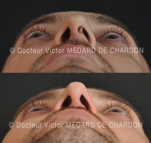 cloison nasale devie chirurgie