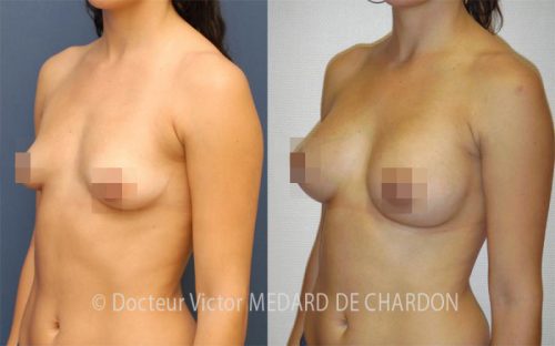 specialiste augmenation mammaire protheses areoles alpes maritimes