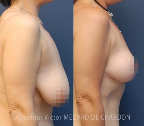 specialiste reduction mammaire paca 83 06