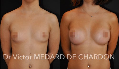 seins-symétriques-implants-mammaires
