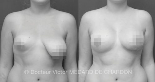 specialiste chirurgie mammaire seins tubereux paca 83 06