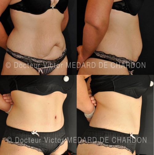 specialiste-abdominoplastie-cannes