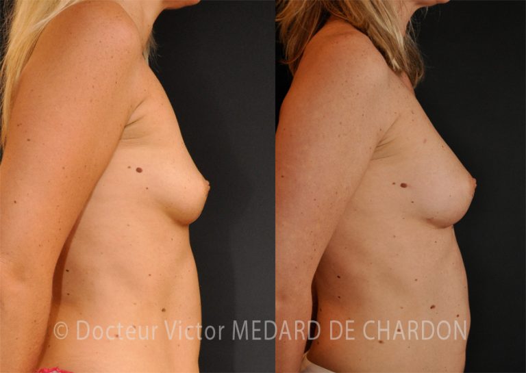 Chirurgie ablation lipome mammaire : Boule de graisse superficielle ou  profonde