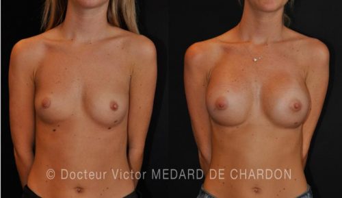 specialiste protheses mammaires aisselle dual plan cannes