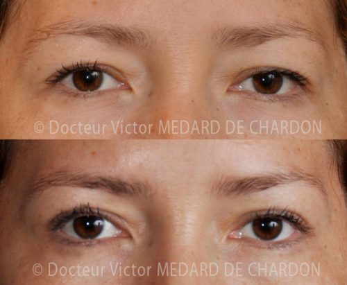 chirurgie esthetique paupieres alpes maritimes