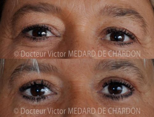 specialiste chirurgie paupieres naturelle