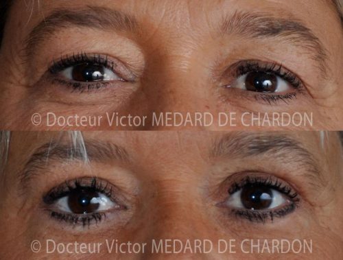 specialiste chirurgie paupieres naturelle