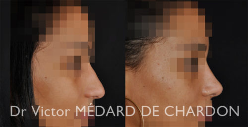 rhinoplastie chirurgie esthetique nez naturel 06 83 13 69