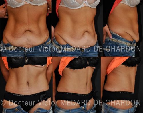 specialiste-abdominoplastie-cannes