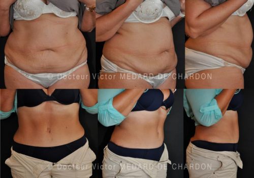 specialiste-abdominoplastie-chirurgie-esthetique-ventre lyon marseille