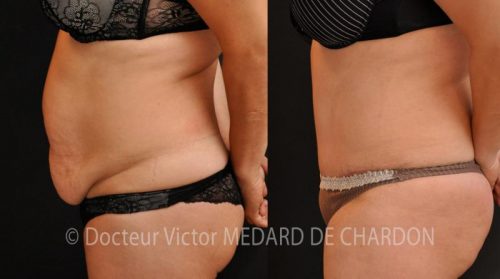 abdominoplastie-ventre