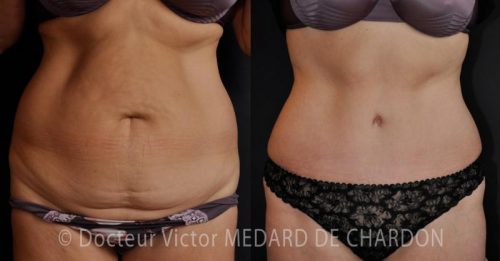 chirurgien-repute-abdominoplastie-ventre-paca-06-83-13-69