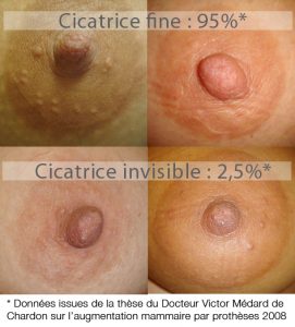 cicatrices invisibles areoles