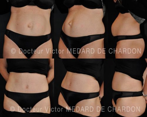 specialiste-abdominoplastie-haute-tension-nice