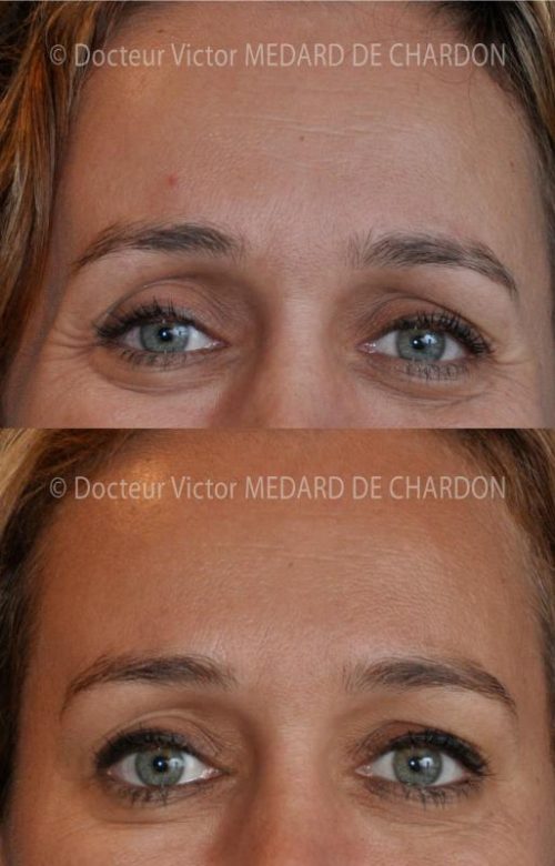 specialiste injection botox cannes