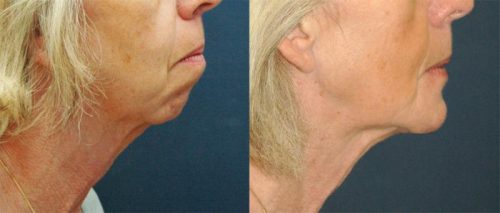 specialiste genioplastie menton fuyant cannes nice monaco marseille