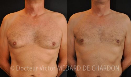 specialiste gynecomastie adipomastie chirurgie mammaire homme