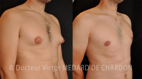 specialiste gynecomastie chirurgie mammaire homme