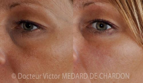 specialiste injection cernes acide hyaluronique cannes