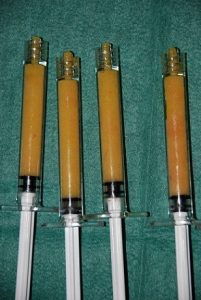 nymphoplastie augmentation injection graisse cannes nice antibes alpes-maritimes monaco