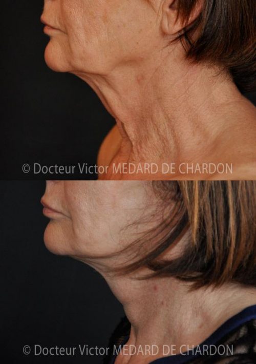 specialiste lifting visage