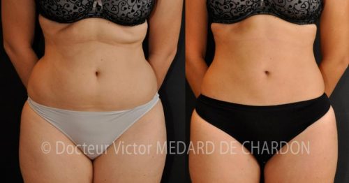 specialiste lipoaspiration ventre france