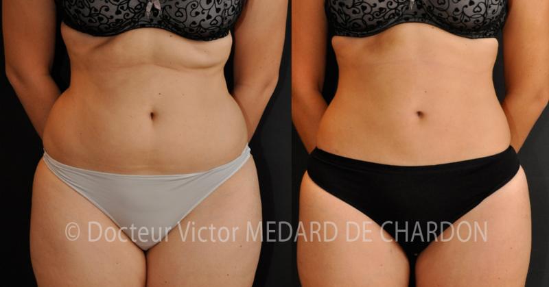 Liposuccion du ventre, abdomen | Dr Medard de Chardon