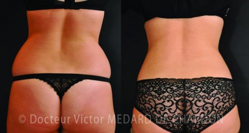 specialiste lipoaspiration ventre