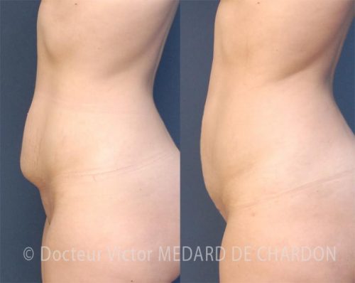 specialiste-abdominoplastie-06