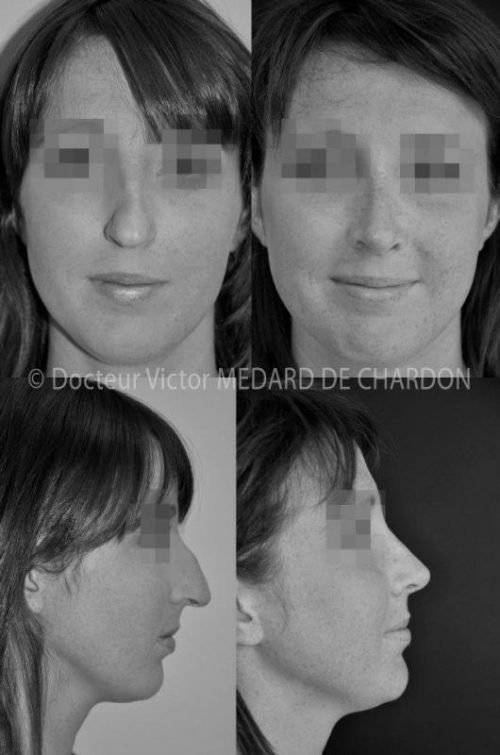 specialiste rhinoplastie marseille lyon corse paris nice