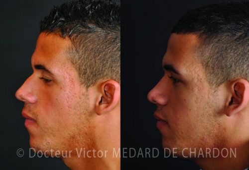 meilleur chirurgien rhinoplastie homme nice marseille cannes