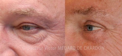 blepharoplastie poches yeux cannes nice monaco