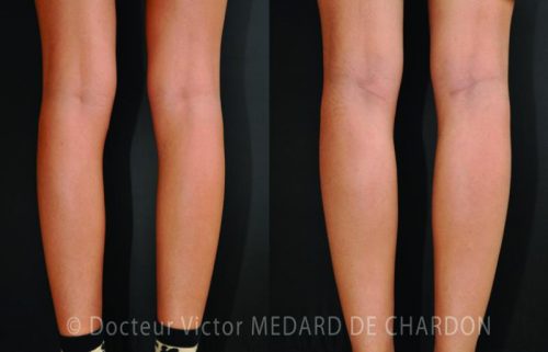 specialiste implants mollets paca
