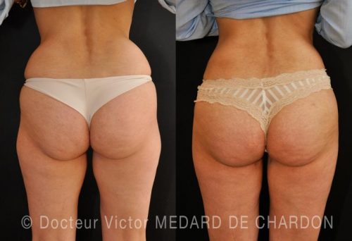 injection graisse fesses nice cannes monaco antibes paca