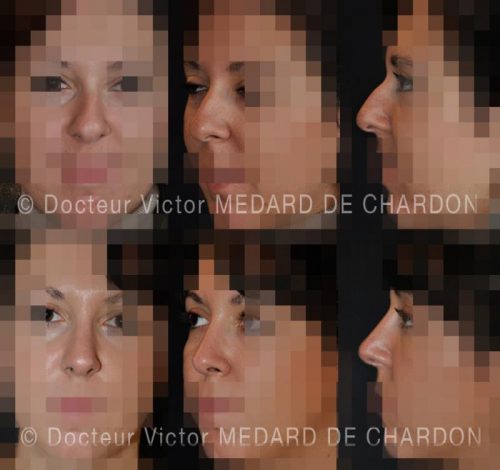 rhinoplastie naturelle nice cannes antibes alpes maritimes