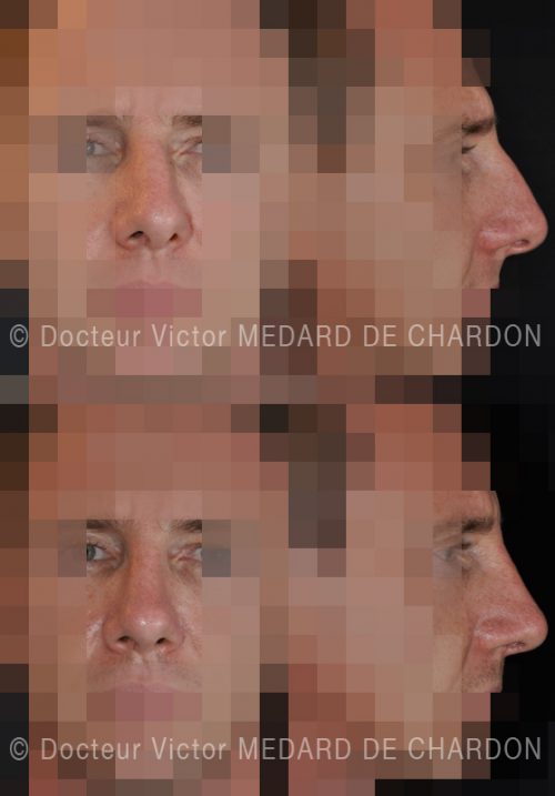 specialiste rhinoplastie fonctionnelle orl