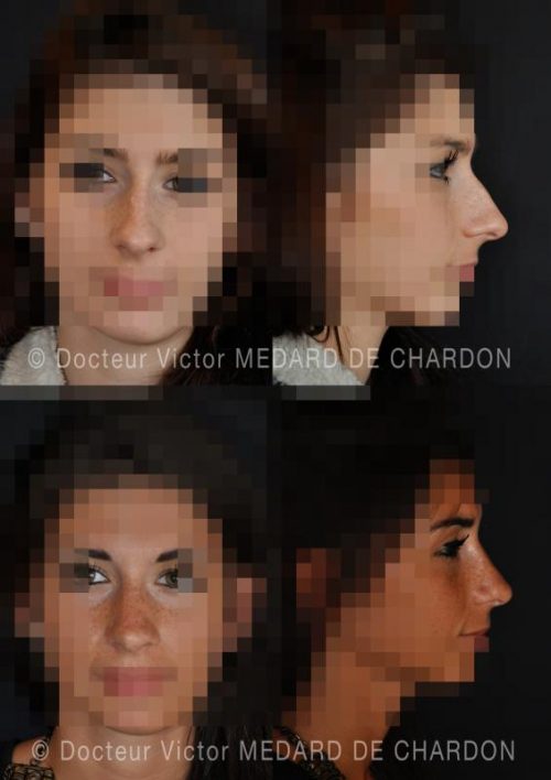 specialiste rhinoplastie voie externe paca alpes maritimes