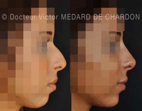 specialiste rhinoplastie medicale injections paca nice antibes monaco