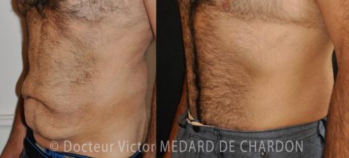 chirurgie-esthetique-ventre