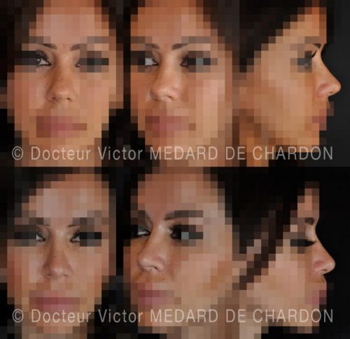 expert rhinoplastie marseille