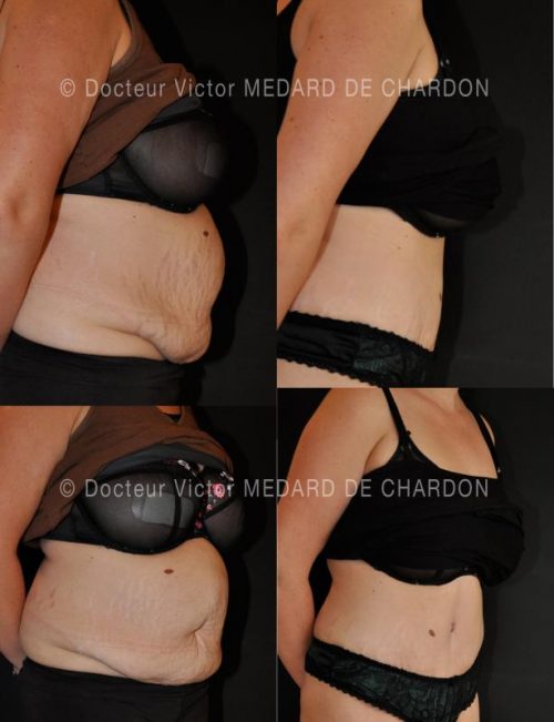 liposuccion ventre chirurgie reparatrice paca cannes nice antibes