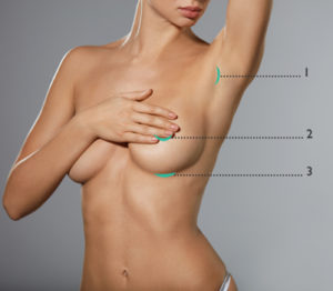 Augmentation mammaire par prothèses | Dr Médard de Chardon