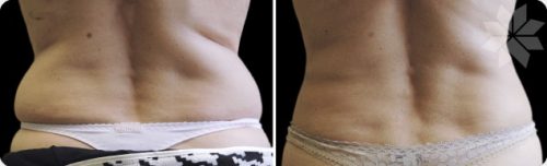 cryolipolyse coolsculpting poignees amour graisse sans chirurgie alpes maritimes