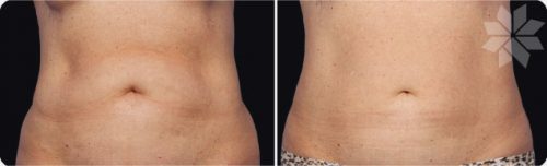 cryolipolyse coolsculpting ventre graisse sans chirurgie alpes maritimes