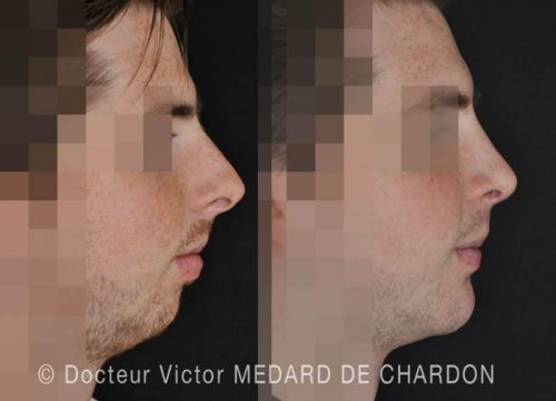 profiloplastie chirurgie nez menton fuyant nice cannes antibes var marseille